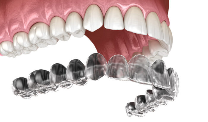 Discover the power of clear aligners