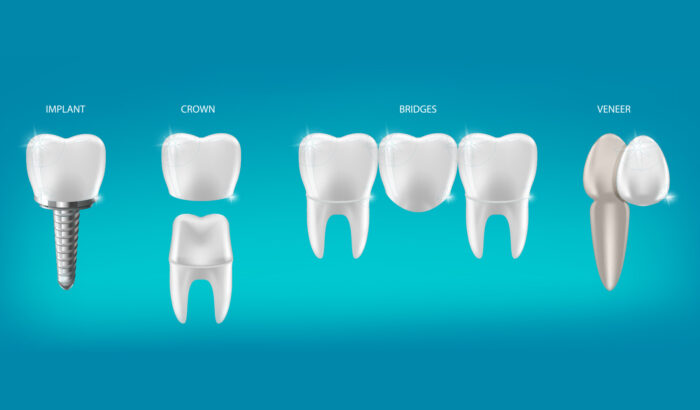 Are dental crowns right for me?