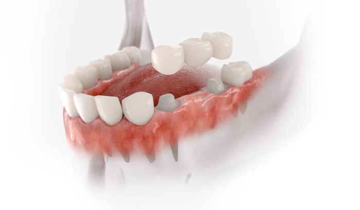 Discover the power of dental bridges