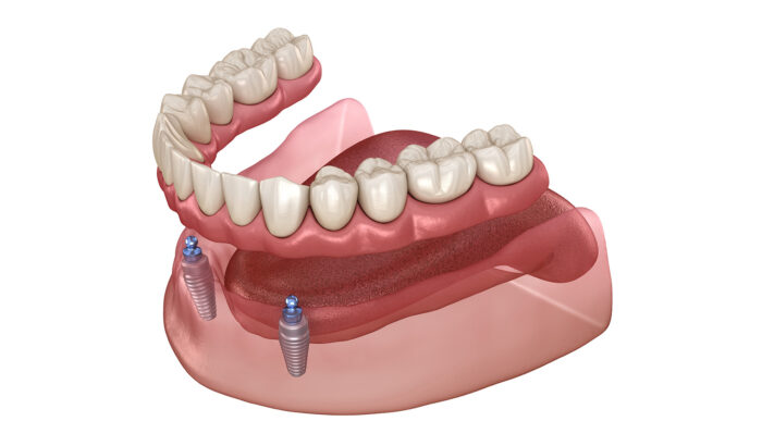 Discover the power of implant retained dentures