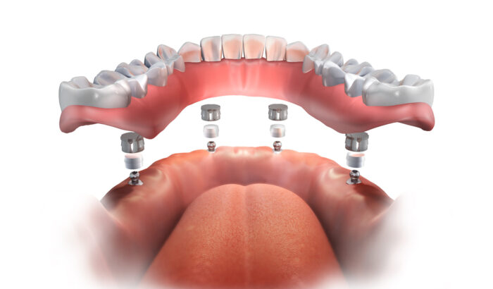 Are implant retained dentures right for me?