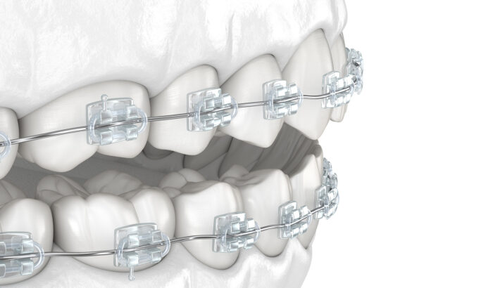 Discover the power of the clear braces