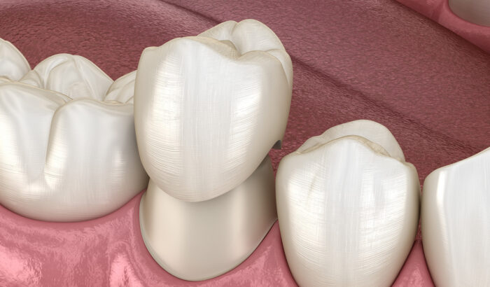 Discover the power of dental crowns