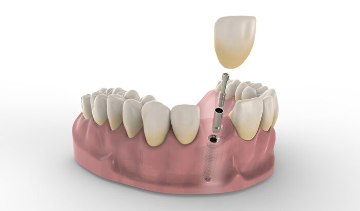 Discover the power of a single dental implant