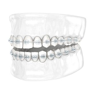 Clear Braces Both Arches