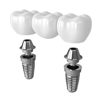 Multiple Dental Implants (3+)
