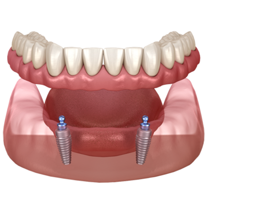 Implant Retained Dentures