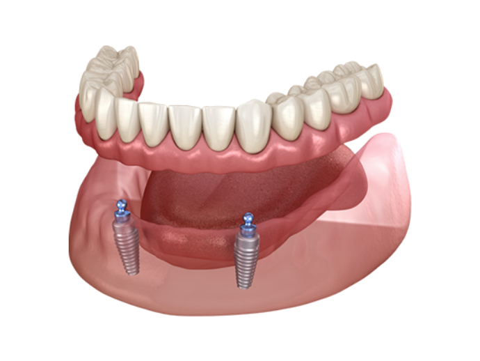 Implant retained dentures pricing